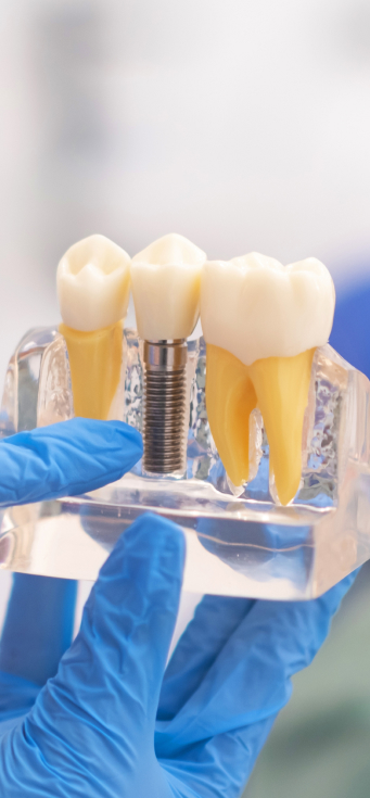 Prothèses implants dentaires Orbe